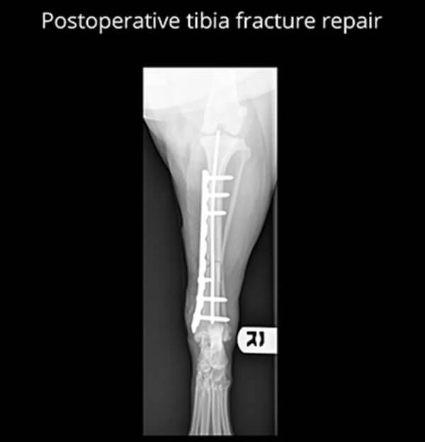 Post Tribia Fracture